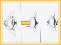 Cirugia ocular refractiva y cirugia ocular.