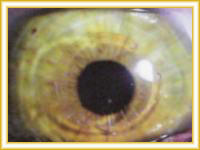 Clinicas de oftalmologia para tratamientos.