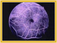 Oftalmologia para diabetes cirugias laser tratamientos de retinopatia diabetica.