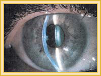 Tratamiento ocular cross linking operacion corneal laser. Operacion con anillos intracorneales intraestromales.